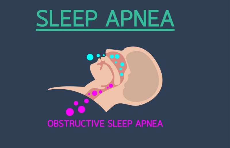 Sleep Apnea